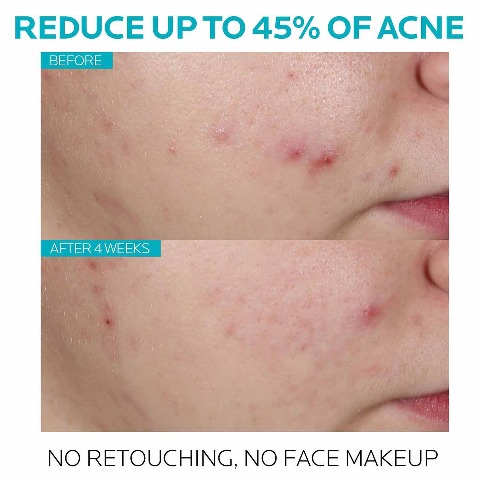 effaclar-salicylic-acid-acne-treatment-serum-z5 7_EffaclarSerum_After-45-days.jpg