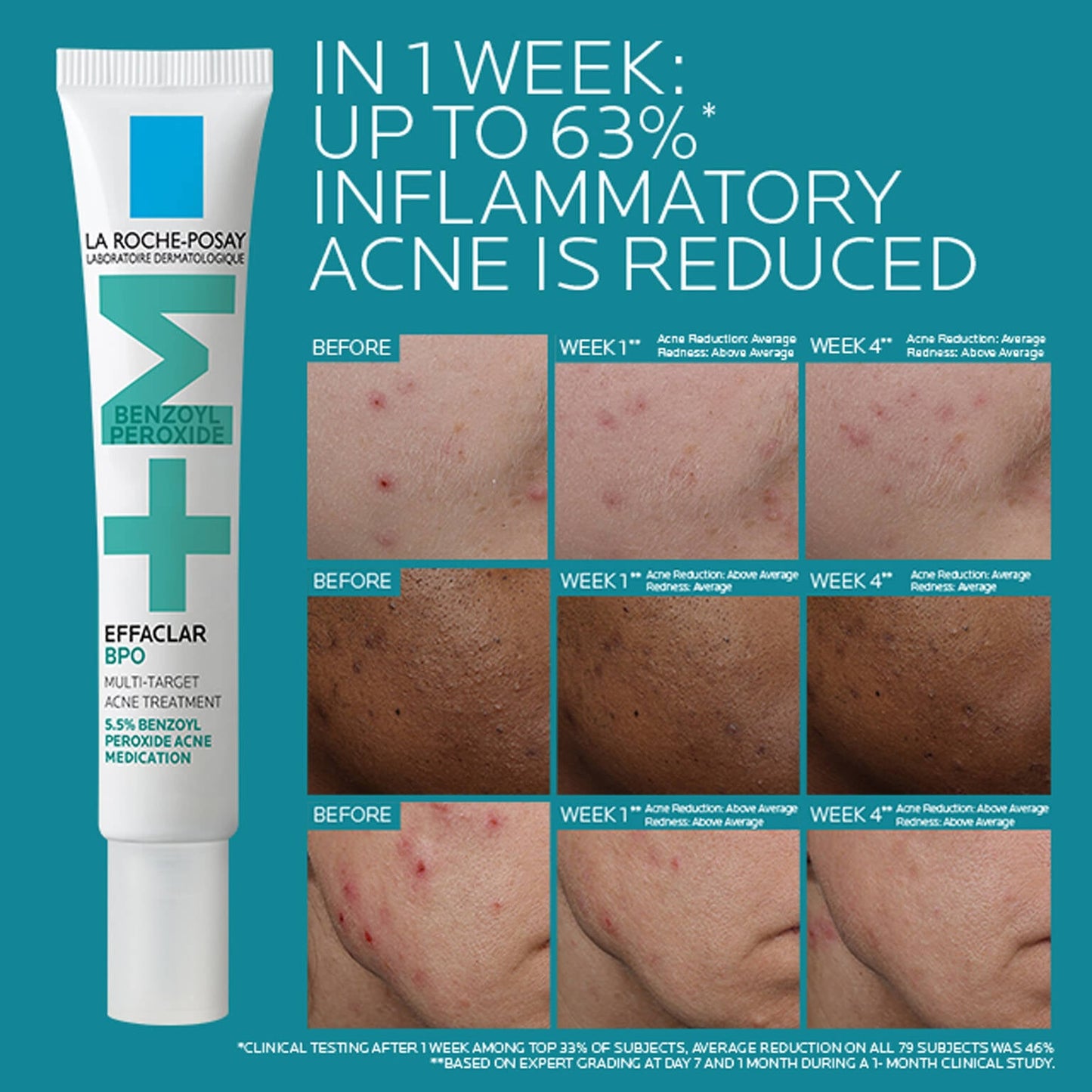 effaclar-bpo-multi-target-acne-treatment-with-5-5-benzoyl-peroxide-p8 EffaclarBPO-ClinicalBA-ATF-1500x1500-2.jpg